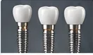 Dental Implants