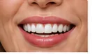 Veneers
